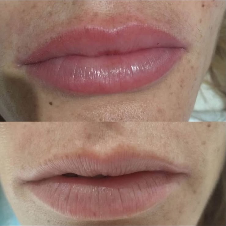 Lèvres naturelles nude — avant et après dermopigmentation