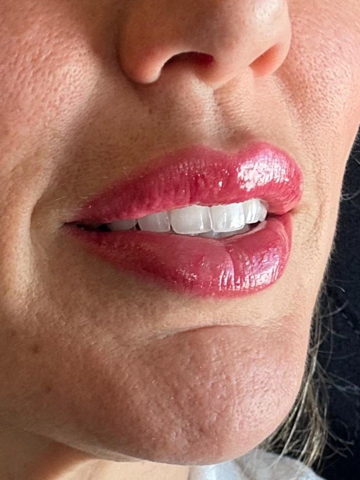 Lèvres pigmentées, teinte rose framboise