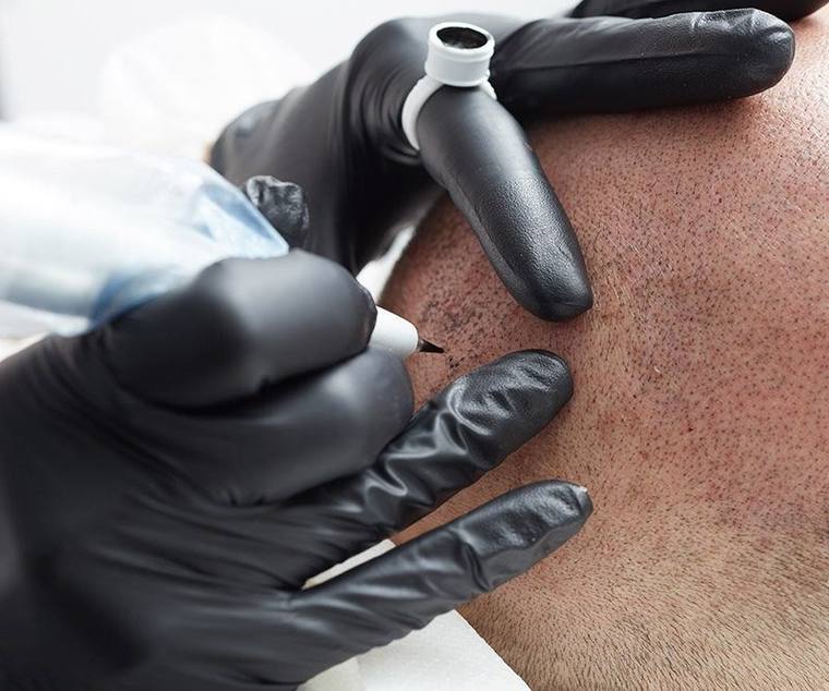 Dermopigmentation du cuir chevelu