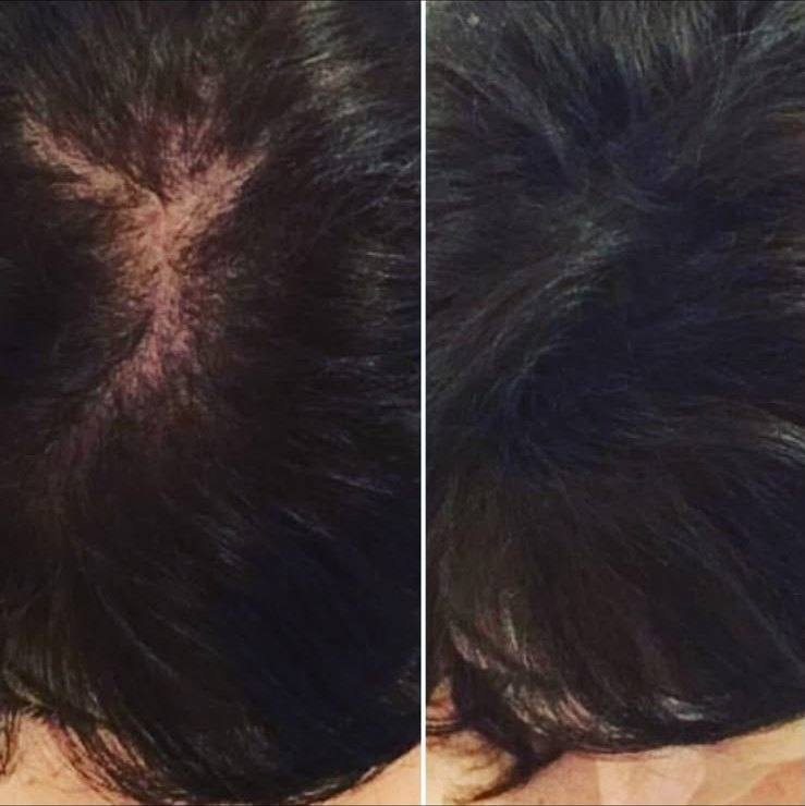 Densification du cuir chevelu par micro-pigmentation — avant et après