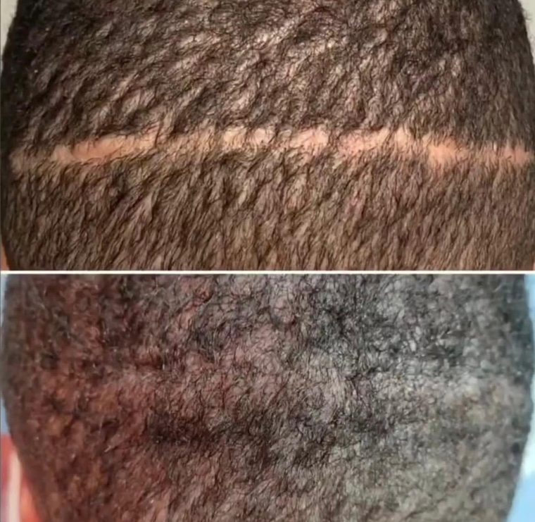 Cicatrice de prélèvement après greffe capillaire camouflée par micro-pigmentation — avant et après