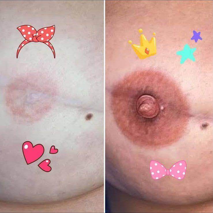 Tatouage d'aréole mammaire — avant et après