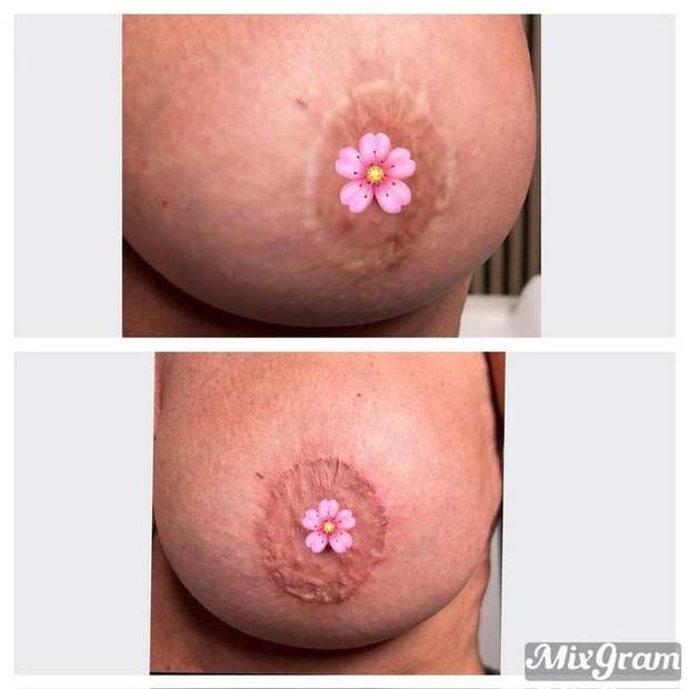 Camouflage de cicatrice après pose d'implants mammaires — avant et après