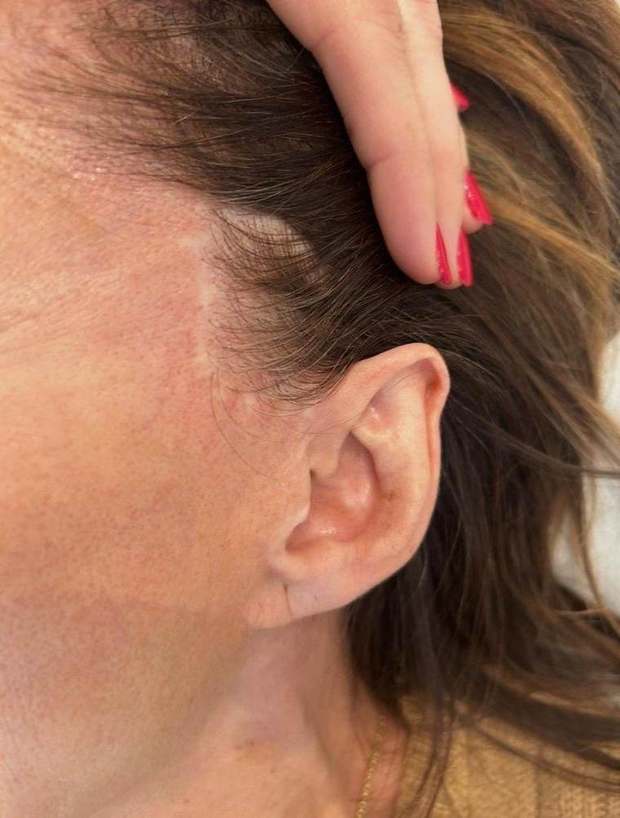 Cicatrice de lifting devant l'oreille, dépigmentée — avant camouflage