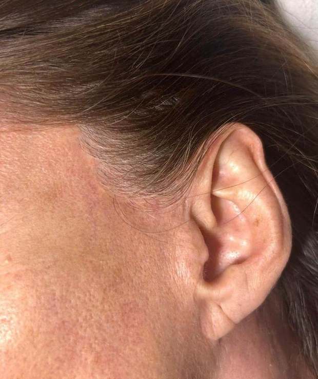 Cicatrice de lifting devant l'oreille, repigmentée — après camouflage